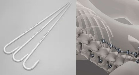 Left to right: Spinal rods; CGI of rod and pedicle screws