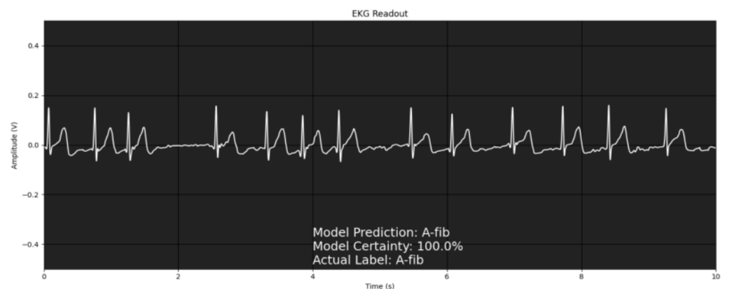 ML model detecting atrial fibrillation from an electrocardiogram